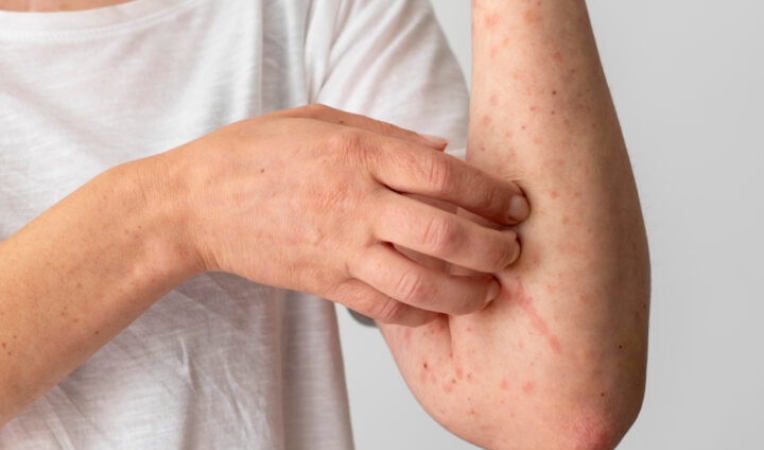 Skin Diseases